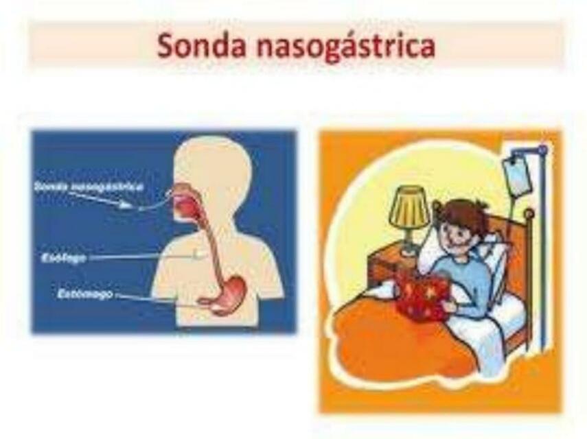 Sonda nasogastrica