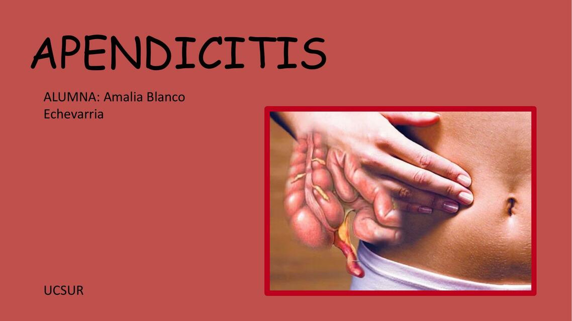 Apendicitis pptx