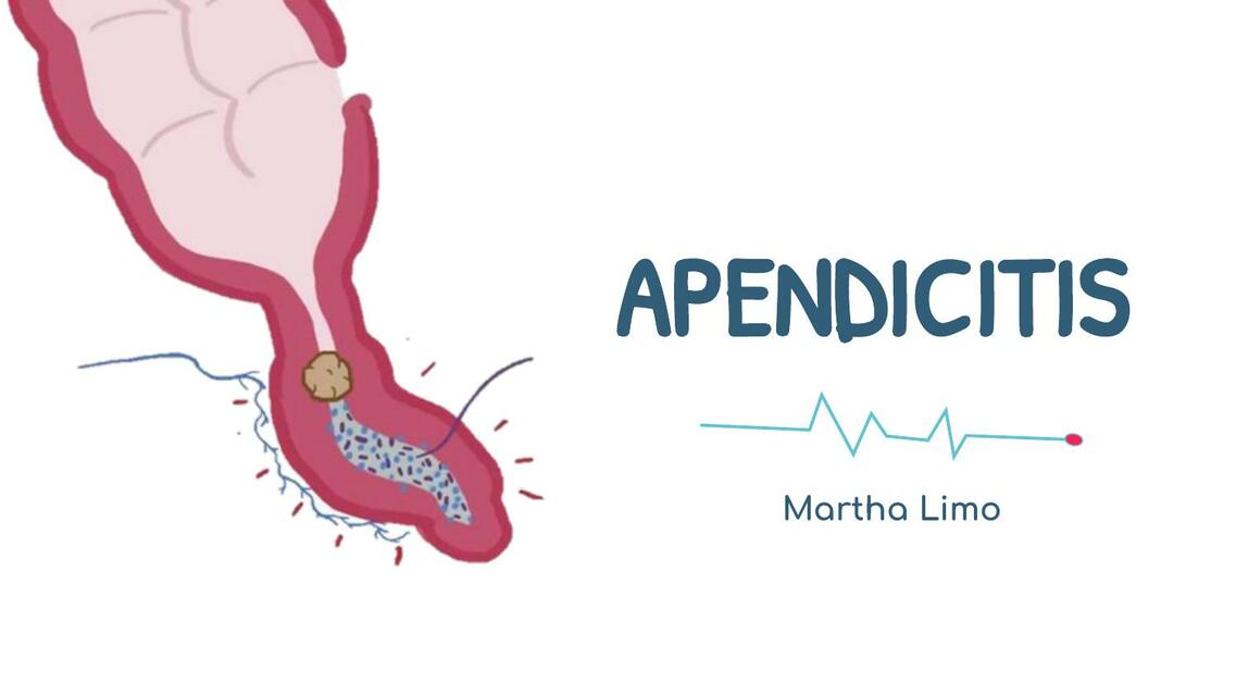 APENDICITIS