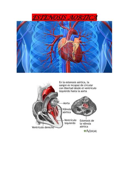 Estenosis Aortica