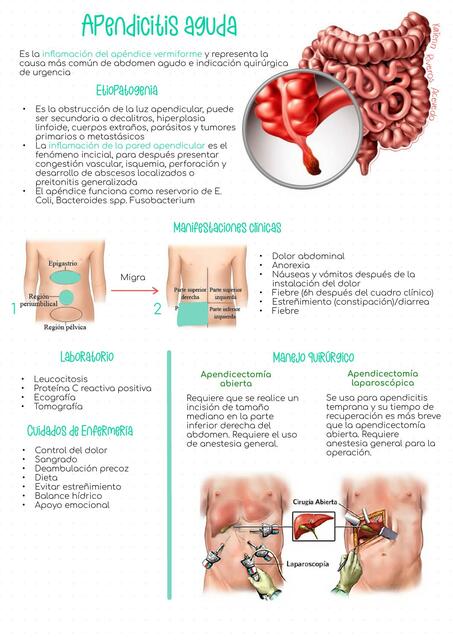 APENDICITIS AGUDA