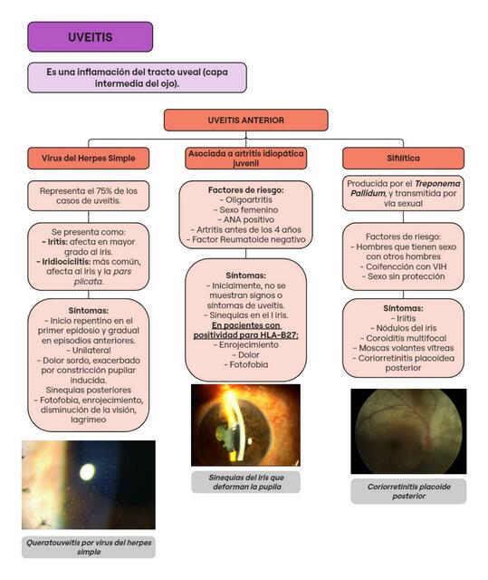 UVEITIS