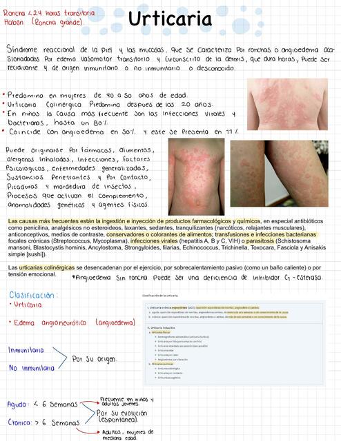 urticaria