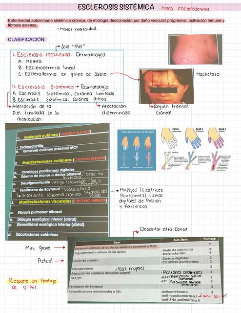 Esclerosis Sistémica