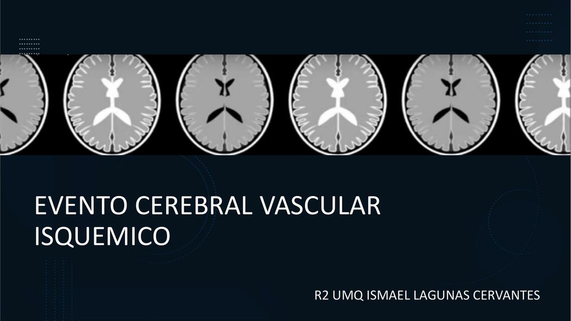 EVC ISQUEMICO