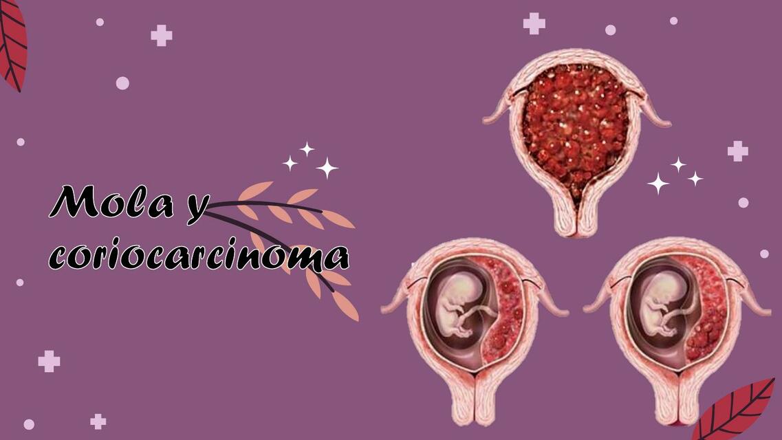 Clase Mola Coriocarcinoma 1