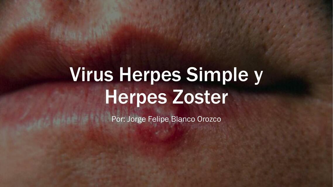 Virus Herpes Simple y Herpes Zoster | Edwin | uDocz