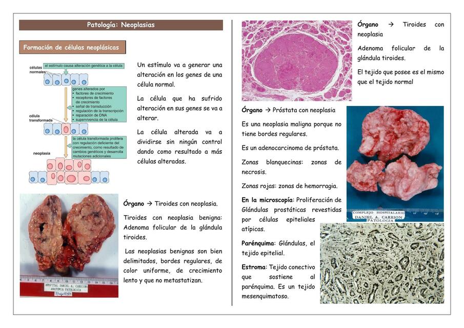 Patología Neoplasias