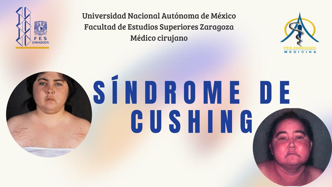 Síndrome de Cushing