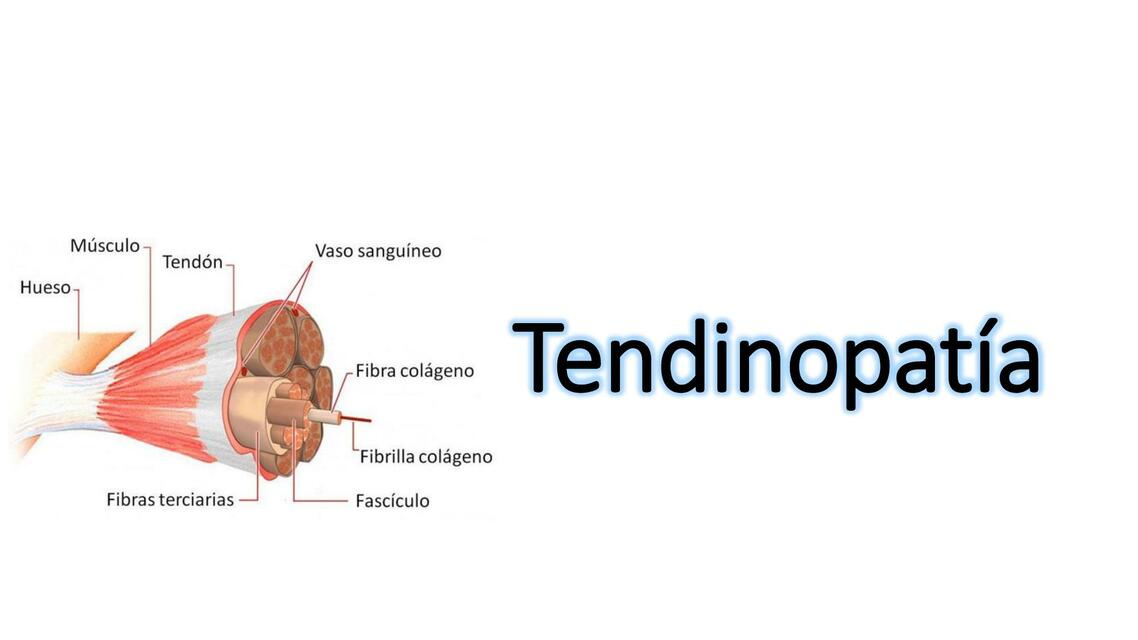 Tendinopatía modeloContinnum